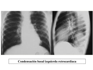 Condensación basal izquierda retrocardíaca 
 