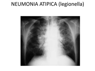 NEUMONIA ATIPICA (legionella) 
 