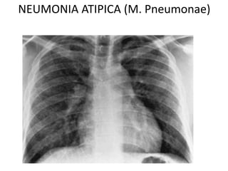 NEUMONIA ATIPICA (M. Pneumonae) 
 