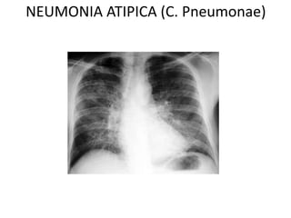 NEUMONIA ATIPICA (C. Pneumonae) 
 