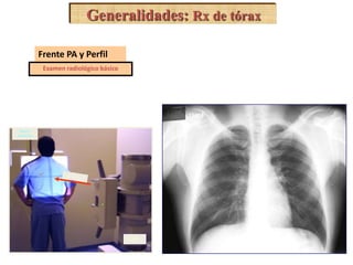 TUBO 
Máxima 
inspiración 
Generalidades: Rx de tórax 
Frente PA y Perfil 
Examen radiológico básico 
 