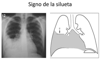 Signo de la silueta 
 