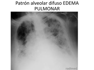 Patrón alveolar difuso EDEMA 
PULMONAR 
 