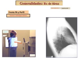 TUBO 
Máxima 
inspiración 
Generalidades: Rx de tórax 
Frente PA y Perfil 
Examen radiológico básico 
Examen radiológico básico Frente PA y Perfil 
 
