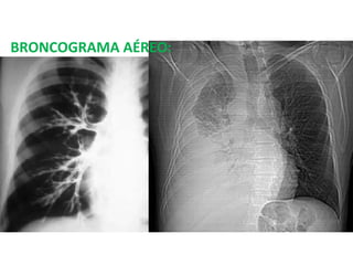 BRONCOGRAMA AÉREO: 
 
