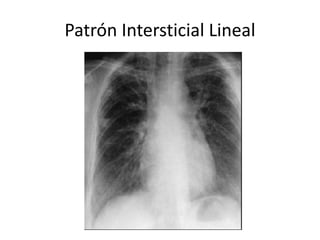 Patrón Intersticial Lineal 
 