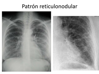 Patrón reticulonodular 
 