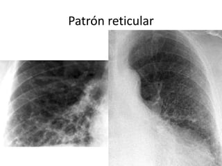 Patrón reticular 
 
