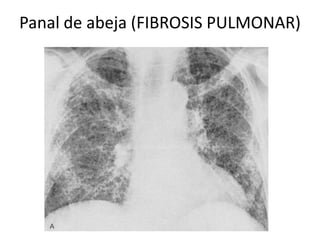 Panal de abeja (FIBROSIS PULMONAR) 
 
