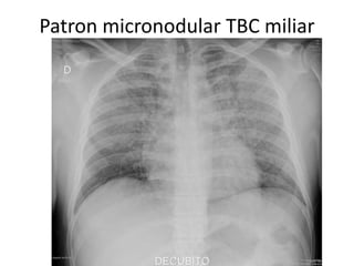 Patron micronodular TBC miliar 
 