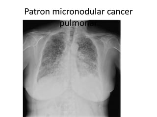 Patron micronodular cancer 
pulmonar 
 