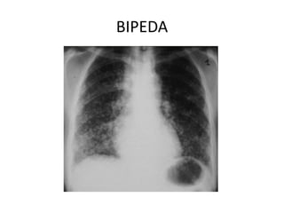 BIPEDA 
 