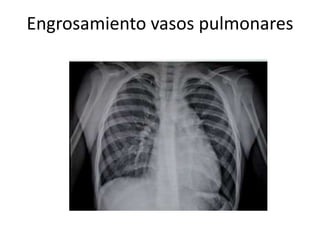 Engrosamiento vasos pulmonares 
 