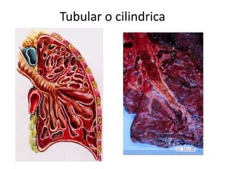 Tubular o cilindrica 
 