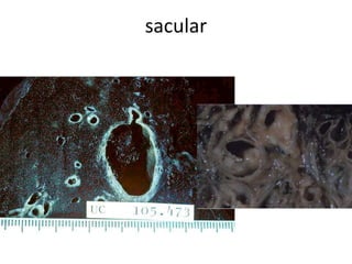 sacular 
 