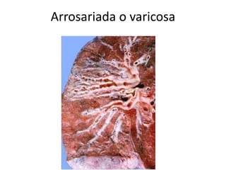 Arrosariada o varicosa 
 