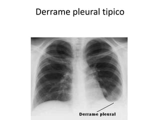 Derrame pleural tipico 
 