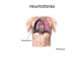 neumotorax 
 