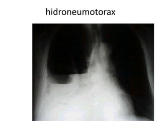 hidroneumotorax 
 