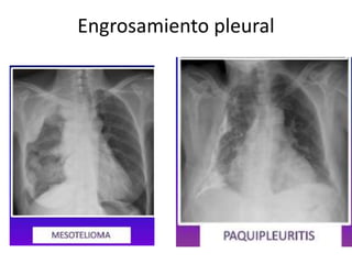Engrosamiento pleural 
 
