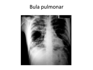 Bula pulmonar 
 