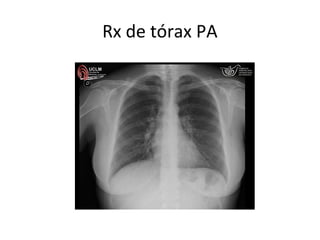Rx de tórax PA
 