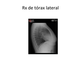 Rx de tórax lateral
 