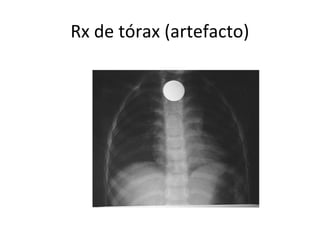 Rx de tórax (artefacto)
 