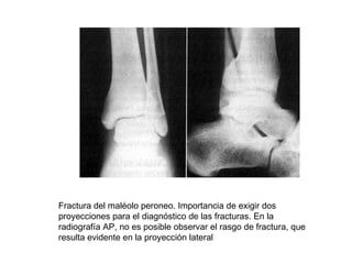 Fractura del maléolo peroneo. Importancia de exigir dos
proyecciones para el diagnóstico de las fracturas. En la
radiografía AP, no es posible observar el rasgo de fractura, que
resulta evidente en la proyección lateral
 