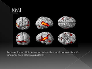 Representación tridimensional del cerebro mostrando activación
funcional ante estímulos auditivos
 