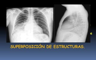 • La radiografía convencional busca representar
un objeto en 3D sobre un plano 2D
• Siempre se deben tomar mínimo 2 proyecciones
AP o PA y Lat.
• Con esto se minimiza el gran problema que tiene
la radiografía convencional:
SUPERPOSICIÓN DE ESTRUCTURAS.
 