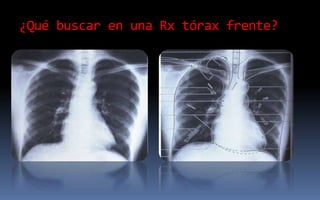 ¿Qué buscar en una Rx tórax frente?
 
