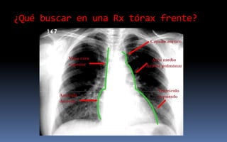 ¿Qué buscar en una Rx tórax frente?
 