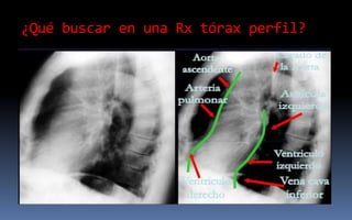 ¿Qué buscar en una Rx tórax perfil?
 