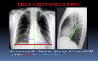 INDICE CARDIOTORACICO NORMAL
valor normal es igual o inferior a 0.5 varia según el biotipo y edad del
paciente. (línea roja / suma de líneas azules )
 