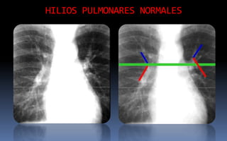 HILIOS PULMONARES NORMALES
 