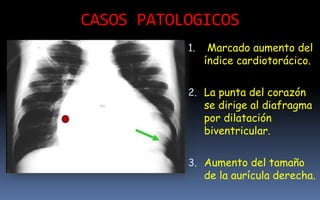 CASOS PATOLOGICOS
1. Marcado aumento del
índice cardiotorácico.
2. La punta del corazón
se dirige al diafragma
por dilatación
biventricular.
3. Aumento del tamaño
de la aurícula derecha.
 