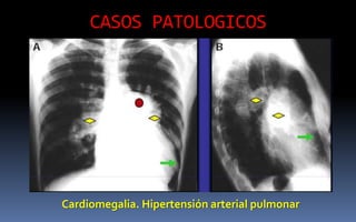 CASOS PATOLOGICOS
Cardiomegalia. Hipertensión arterial pulmonar
 