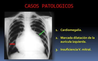 CASOS PATOLOGICOS
1. Cardiomegalia.
2. Marcada dilatación de la
aurícula izquierda.
3. InsuficienciaV. mitral.
 