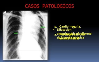 CASOS PATOLOGICOS
1. Cardiomegalia.
2. Patología valvular
aortica-mitral
• Dilatación
aneurismática fusiforme
de la aorta torácica
 