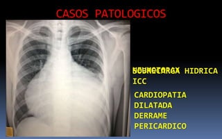 CASOS PATOLOGICOS
NEUMOTORAXSOBRECARGA HIDRICA
ICC
CARDIOPATIA
DILATADA
DERRAME
PERICARDICO
 