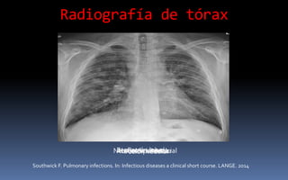 Radiografía de tórax
Patrón lobarBronconeumoníaNeumonía intersticialAbsceso pulmonarPatrón nodular
Southwick F. Pulmonary infections. In: Infectious diseases a clinical short course. LANGE. 2014
 