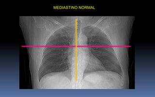 MEDIASTINO NORMAL
 