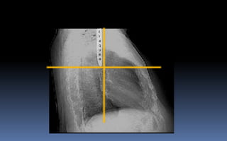 L a t e r a l
t
r
a
q
u
e
a
CATEDRA DE RADIOLOGIA U.N.L.P. Mediastino normal Edición 2004
 