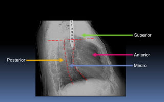 Compartimientos mediastínicos
Anterior
Medio
Superior
Posterior
t
r
a
q
u
e
a
CATEDRA DE RADIOLOGIA U.N.L.P. Mediastino normal Edición 2004
 