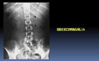 COLELITIASISNEFROMEGALIA
 