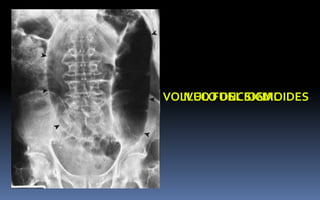 ILEO FUNCIONALVOLVULO DEL SIGMOIDES
 