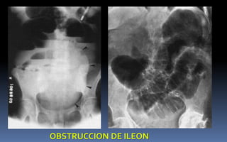 OBSTRUCCION DE ILEON
 