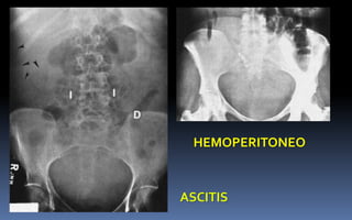 ASCITIS
HEMOPERITONEO
 
