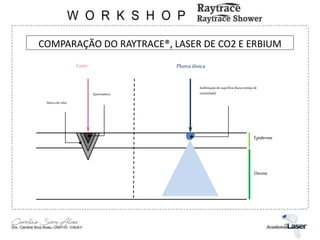 COMPARAÇÃO DO RAYTRACE®, LASER DE CO2 E ERBIUM
Marca decalor
Laser
Queimadura
Epiderme
Derme
Pluma iônica
Sublimaçãodesuperfície(baixotempode
inatividade)
 